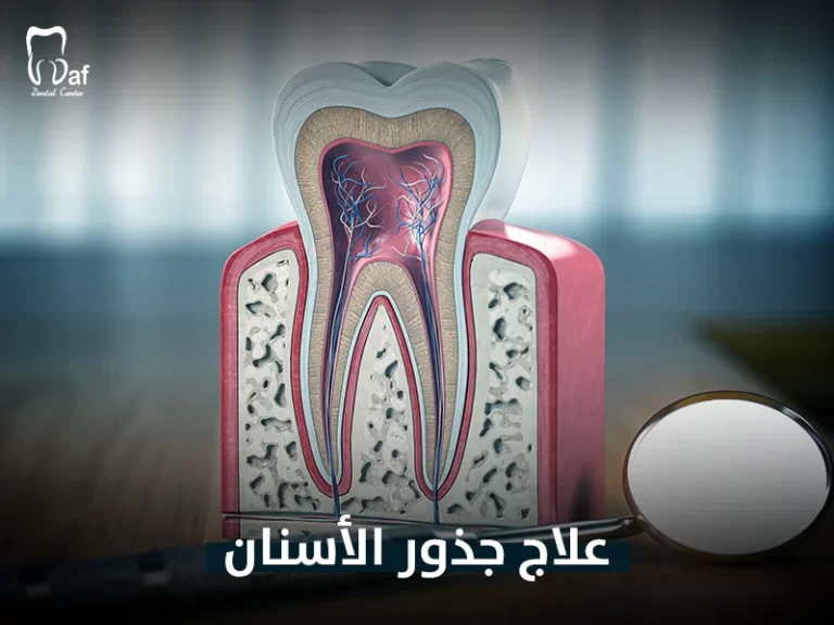 علاج جذور الأسنان