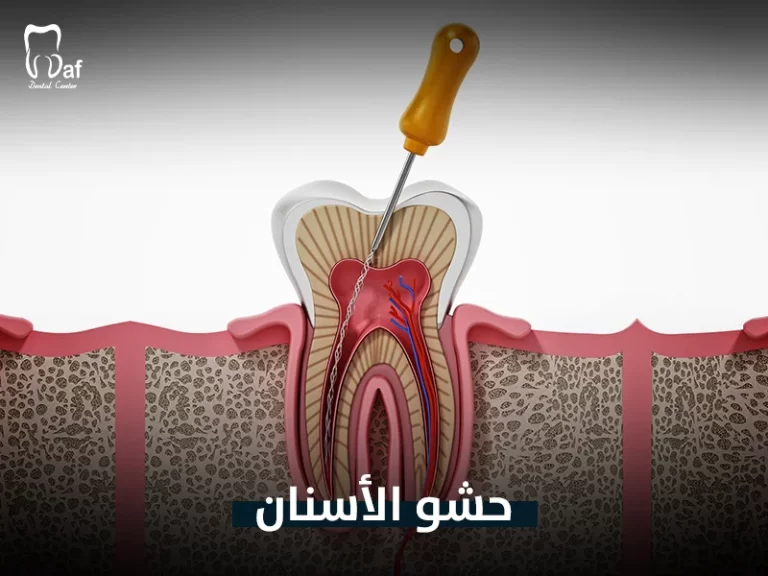 حشو الأسنان