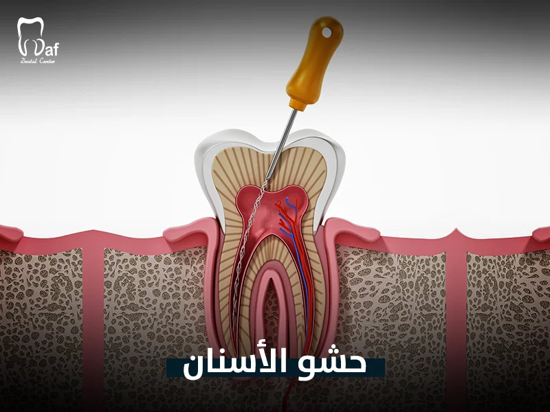 حشو الأسنان