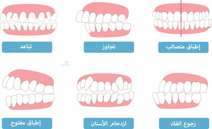 أعراض بروز الأسنان