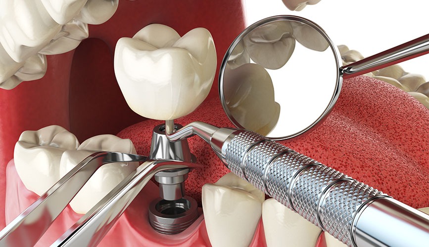 الزرعات السنية (Dental Implants)