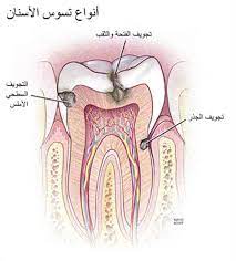 انواع تسوس الأسنان