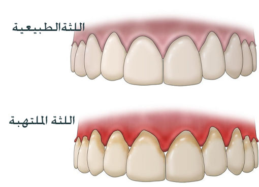 تشخيص التهاب اللثة