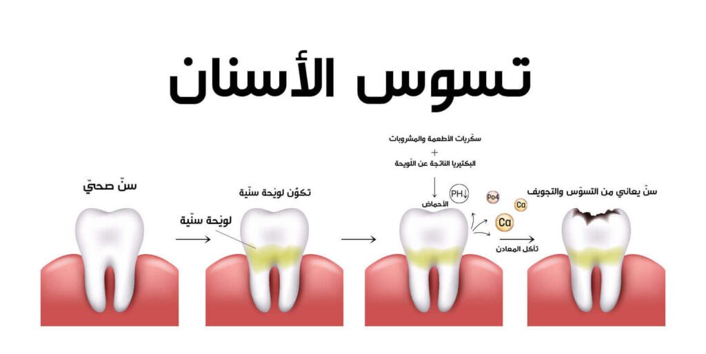 تسوس الأسنان