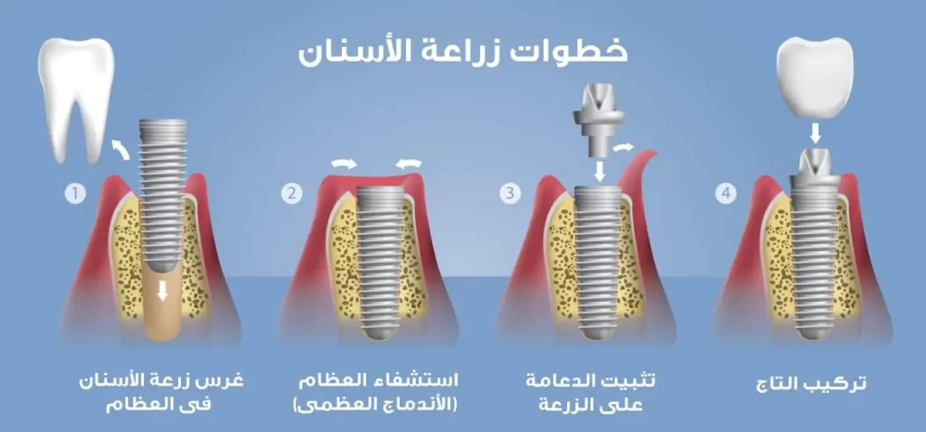 خطوات زراعة الأسنان