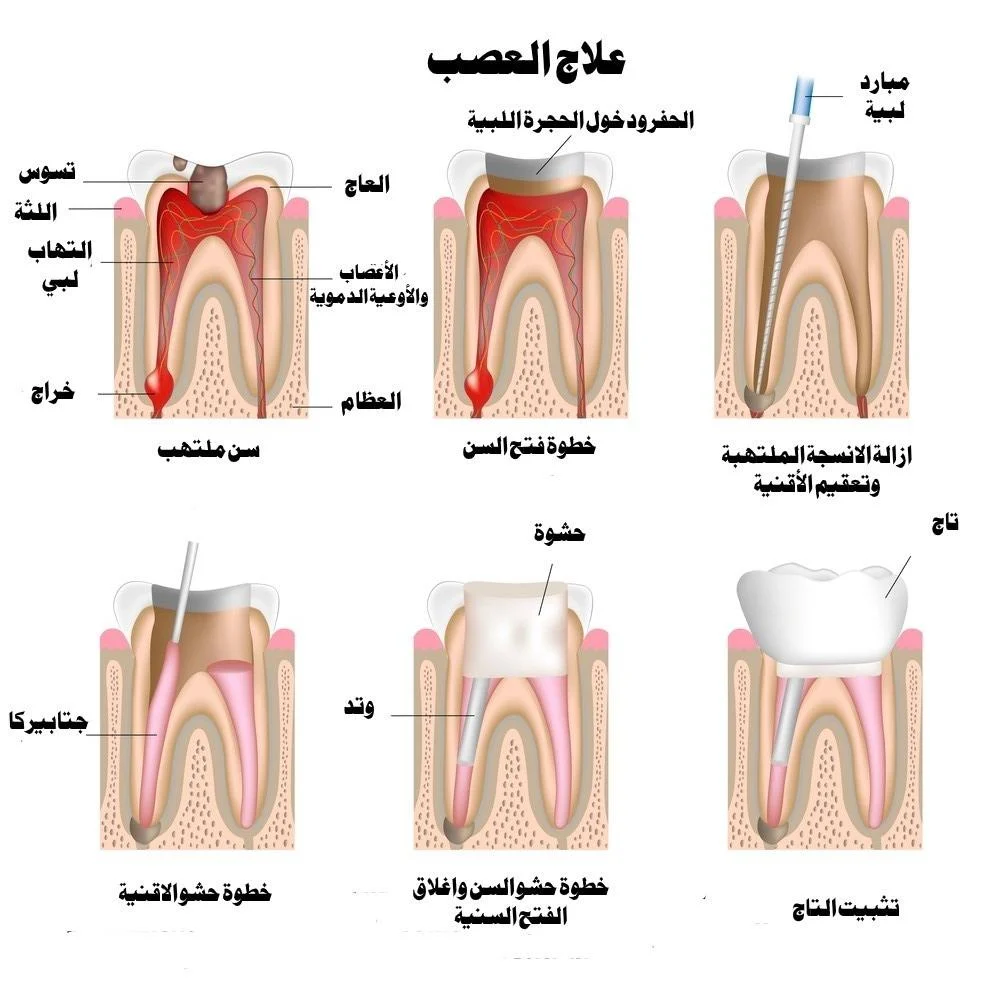 خطوات علاج عصب الأسنان