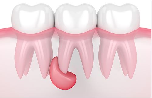 مضاعفات جراحة دواعم السن