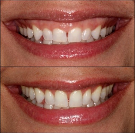 gums contouring